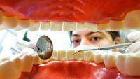 Veszélyes kapcsolat a fogak állapota és az agyvérzés között